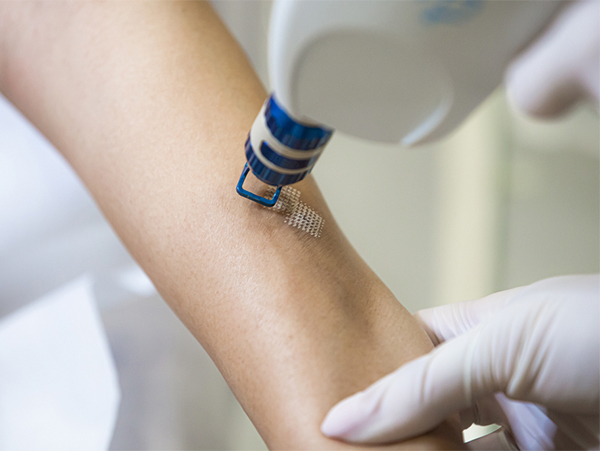 Fractional laser Scar Acne